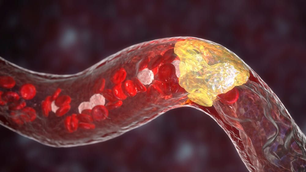 Ilustrație medicală — placă de aterom care îngustează o arteră